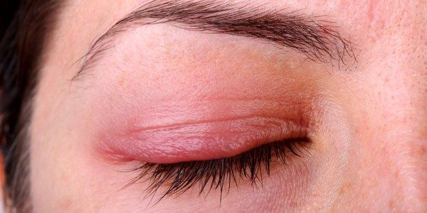 Contact Dermatitis آماس پوست