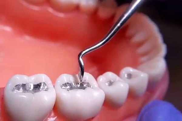 dental amalgams