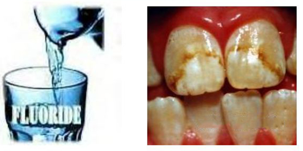 Fluoride What Is It فلوراید چیست
