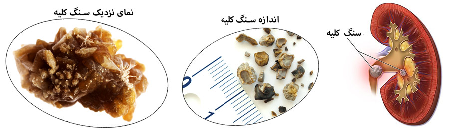kidney stones surface